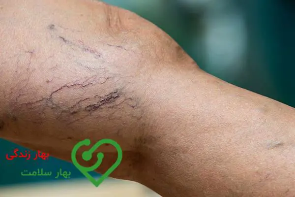 واریس طنابی چیست و چگونه ایجاد می شود؟