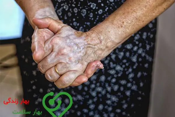 واریس دست چیست و چه نشانه هایی دارد؟