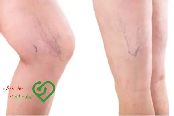 درمان واریس