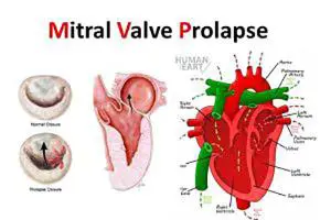 دریچه میترال و افتادگی آن