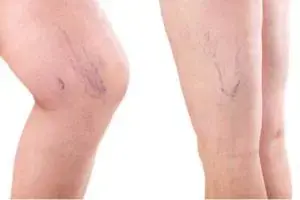 واریس واریس