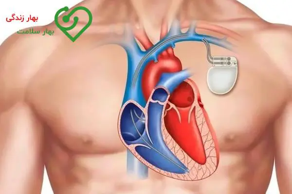   علائم و نشانه‌های آریتمی قلبی 