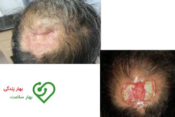   قبل و بعد درمان زخم کلینیک بهار زندگی 