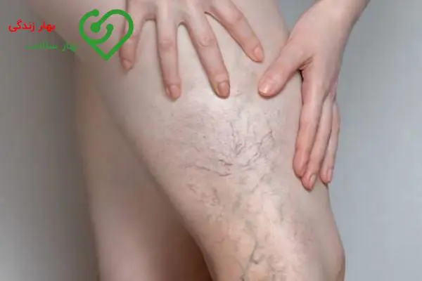 ارتباط واریس و قاعدگی: واریس با پریود ماهانه تشدید میشود؟