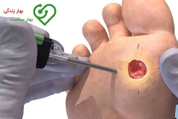    آیا درمان سوختگی بیماران دیابتی در خانه امکان پذیر است؟ 