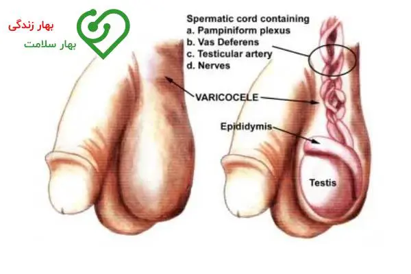 واریکوسل و ناباروری: آیا واریس بیضه باعث بچه دارنشدن مردان است؟ واریکوسل و ناباروری: آیا واریس بیضه باعث بچه دارنشدن مردان است؟