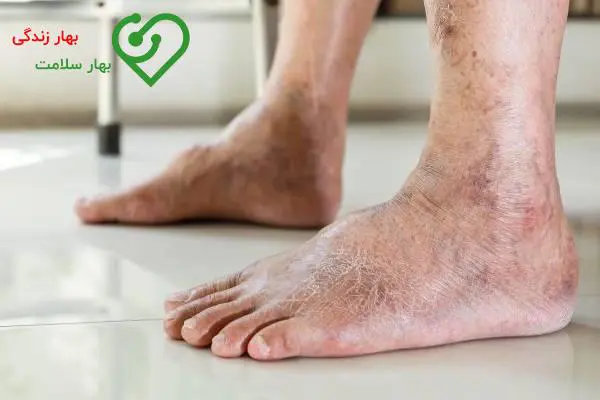 درمان قطعی نوروپاتی دیابتی