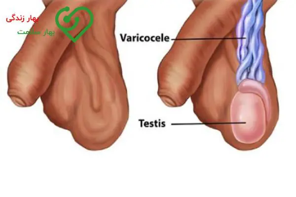 آیا واریس بیضه باعث ناباروری میشود