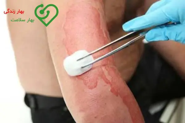   ۸ درمان خانگی سوختگی با روغن که پوست شما را نجات می‌دهد 