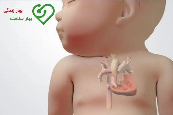 انواع بیماری های مادرزادی قلب