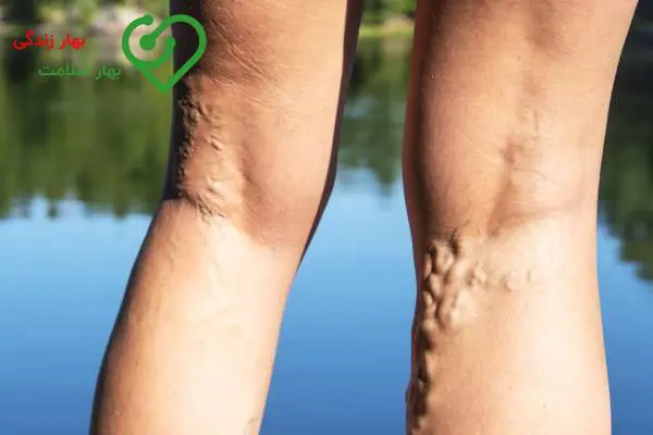 آیا واریس با آب نمک درمان می‌شود؟