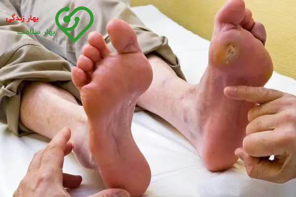 درمان زخم دیابتی در منزل