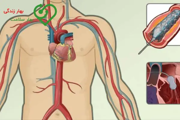   عوارض آنژیو بعد از سکته قلبی چیست؟ 