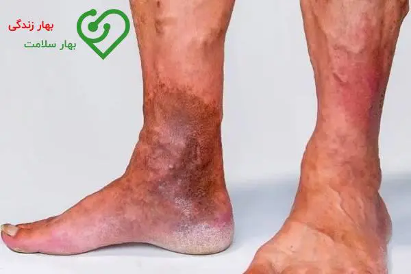 چرا واریس میتواند کشنده باشد؟