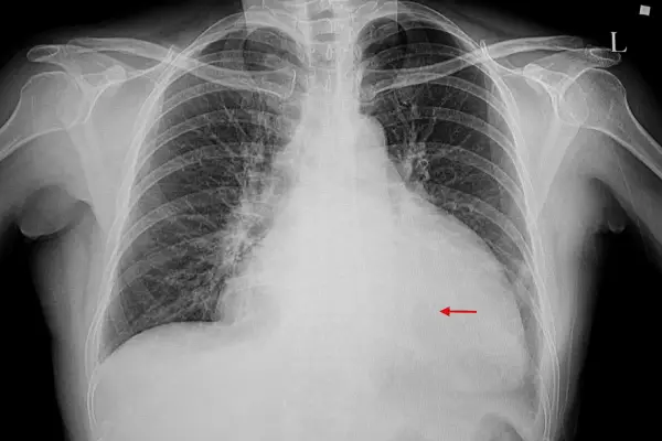 درمان قطعی بزرگ شدن قلب
