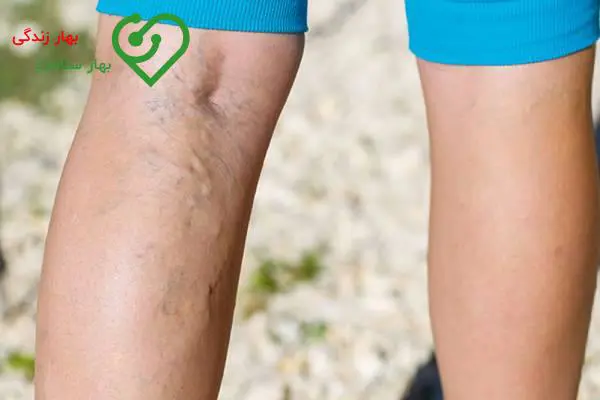 انواع واریس پا و درمان آنها انواع واریس پا و درمان آنها