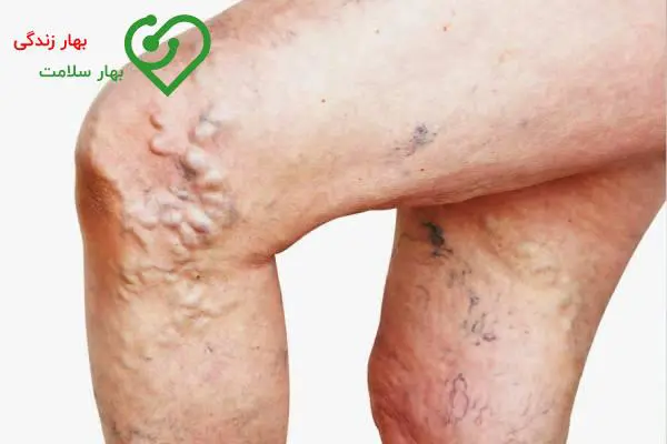 غلظت خون و واریس