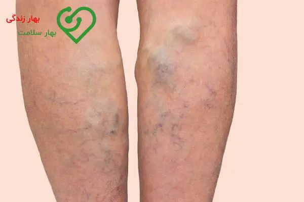 علائم واریسی که درمان نشده    علائم واریسی که درمان نشده
