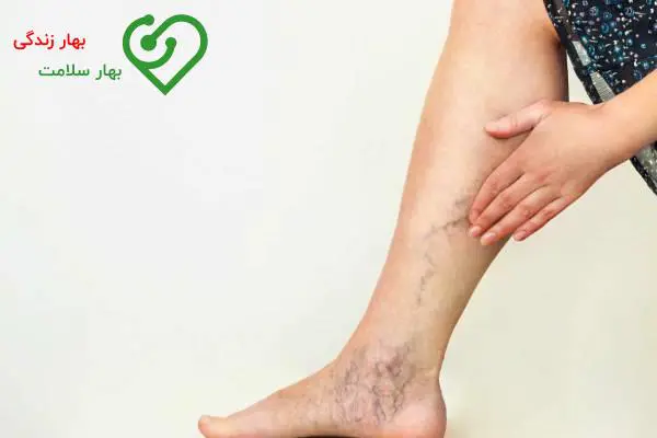 آیا رگ های واریسی سلامت افراد را تهدید می کنند؟ به عبارت دیگر آیا واریس کشنده است؟    آیا رگ های واریسی سلامت افراد را تهدید می کنند؟ به عبارت دیگر آیا واریس کشنده است؟