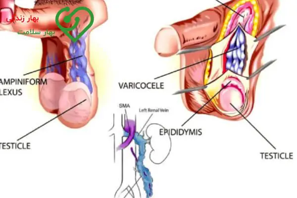   عمل جراحی باز واریکوسل یا واریس بیضه 