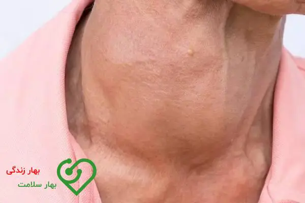 درمان قطعی بیماری هاشیموتو