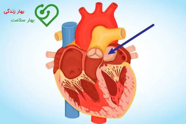 نارسایی قلبی؛ شناخت علت و درمان (تایید شده توسط پزشک)