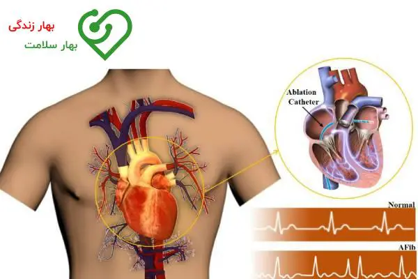   عوامل خطر آریتمی قلبی 