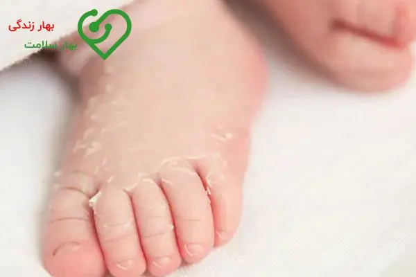   چطور از بروز علائم سوختگی پا در نوزادان و کودکان جلوگیری کنیم؟ 