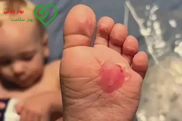 چطور متوجه سوختگی پای کودکم شوم؟