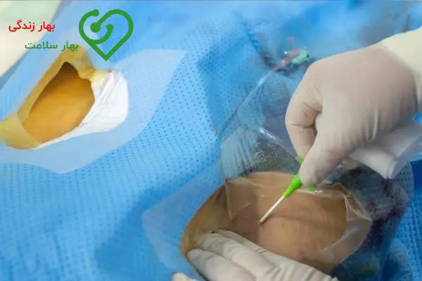 درمان درد دست بعد از آنژیوگرافی