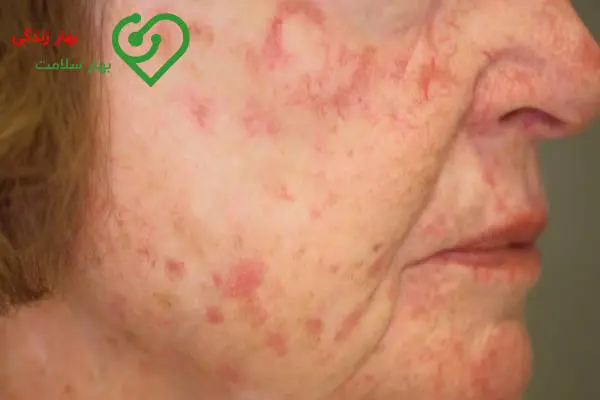 سرطان پوست چیست؟ آشنایی با علائم و نحوه تشخیص