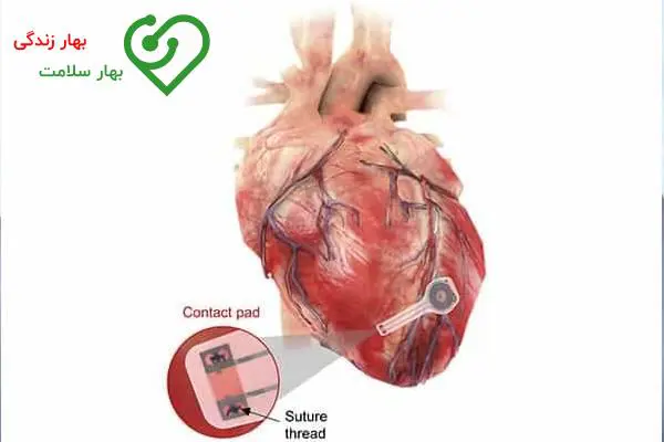 همه چیز در مورد گذاشتن باطری (باتری) در قلب