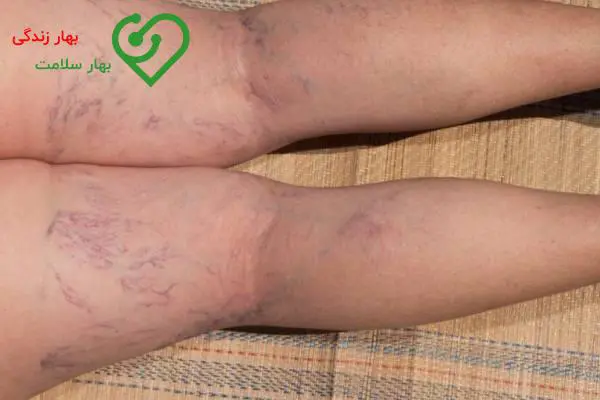 درمان واریس عنکبوتی پا درمان واریس عنکبوتی پا