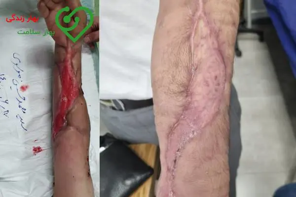   قبل و بعد درمان زخم در کلینیک بهار زندگی 