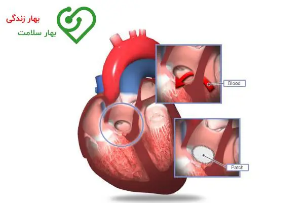 هزینه عمل بستن سوراخ قلب بزرگسالان