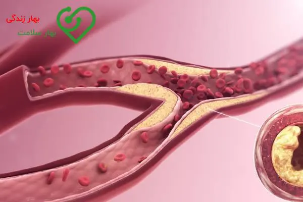 علت گرفتگی سه رگ اصلی قلب چیست؟