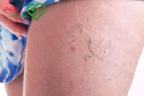 شناخت علائم و درمان انواع واریس خفیف و شدید پا (طنابی و شاخه ای) شناخت علائم و درمان انواع واریس خفیف و شدید پا (طنابی و شاخه ای)