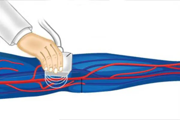   Sonography of leg varicose veins 