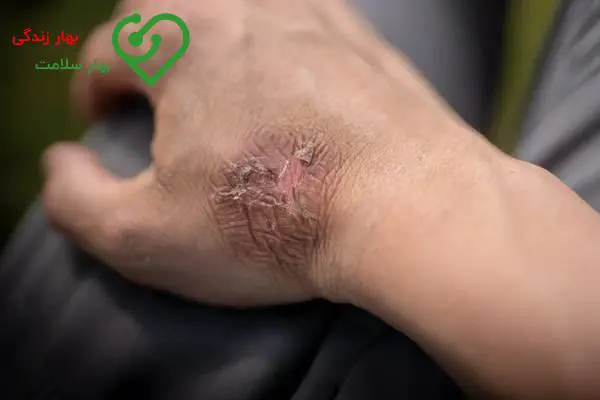 از بین بردن جای سوختگی فوری