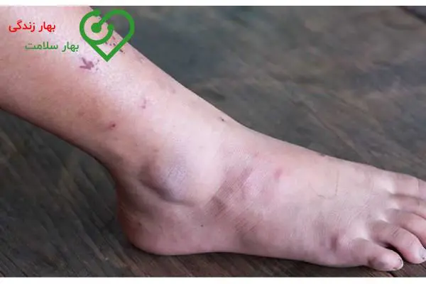 درمان زخم ساق پای دیابتی