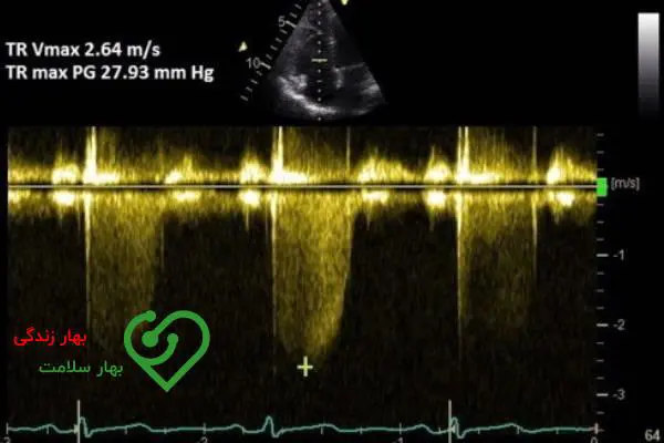 درمان جدید فشار خون ریوی