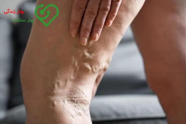 بررسی واگیر دار بودن واریس