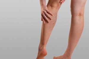 هرچه باید درباره عوارض واریس پا بدانید