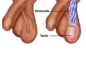 آیا واریس بیضه باعث ناباروری میشود