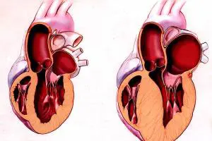 فشار خون و ارتباط ان با ضخیم شدن دیواره قلب