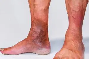 چرا واریس میتواند کشنده باشد؟