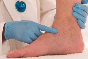 داروی واریس پا چیست؟