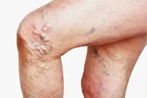 غلظت خون و واریس