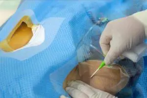 درمان درد دست بعد از آنژیوگرافی