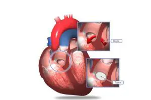 هزینه عمل بستن سوراخ قلب بزرگسالان
